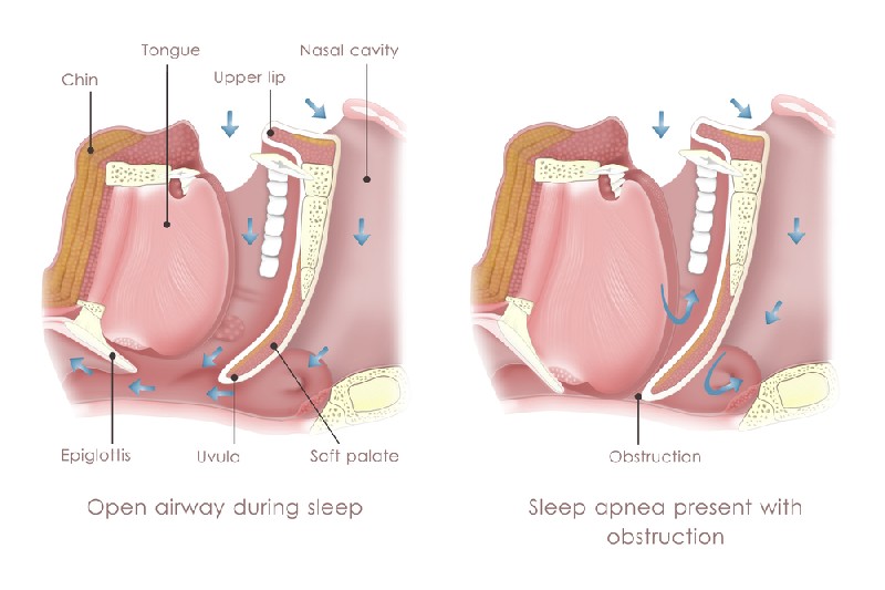 Sleep-Apnea-Dentist-Mesa-AZ
