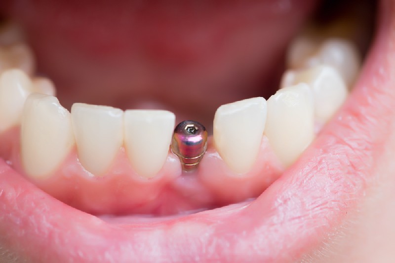 Dental-Implants-Mesa-AZ