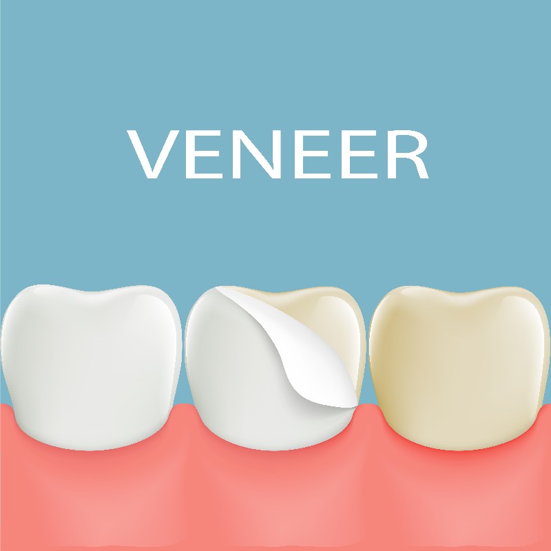 Dental-Veneers-Mesa-AZ