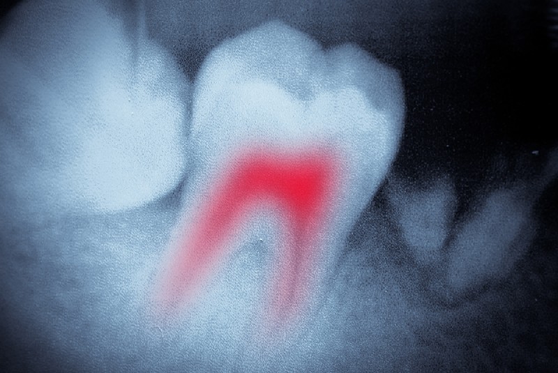 Endodontics-Mesa-AZ