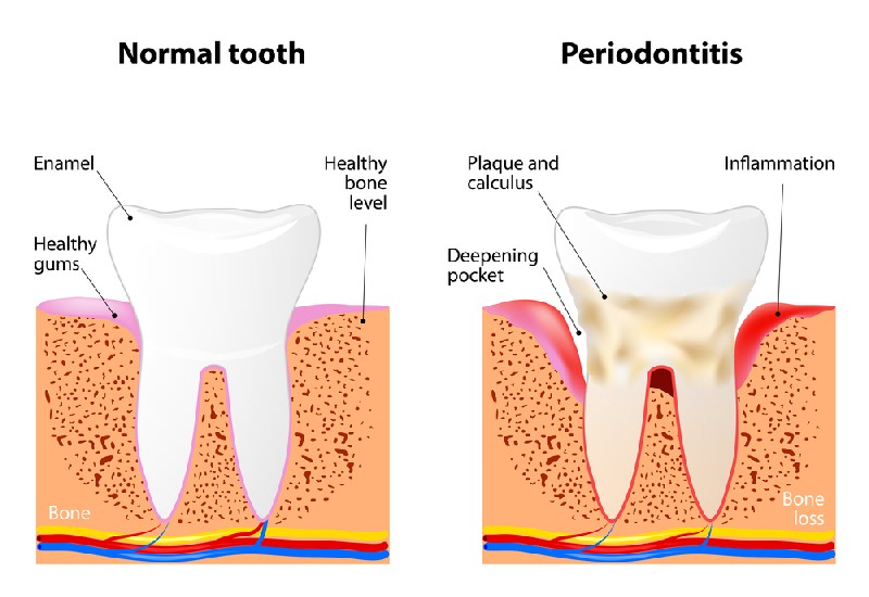 Periodontal-Disease-Mesa-AZ