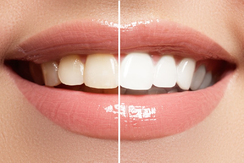 Professional-Teeth-Whitening-Mesa-AZ