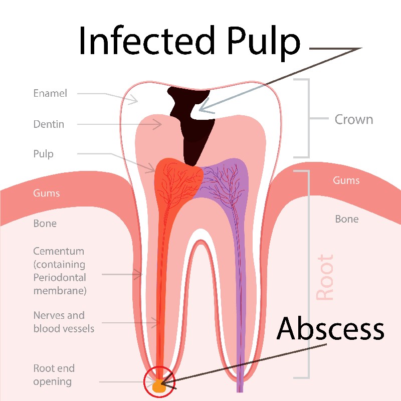 Root-Canal-Mesa-AZ