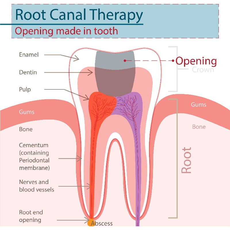 Root-Canal-Procedure-Mesa-AZ