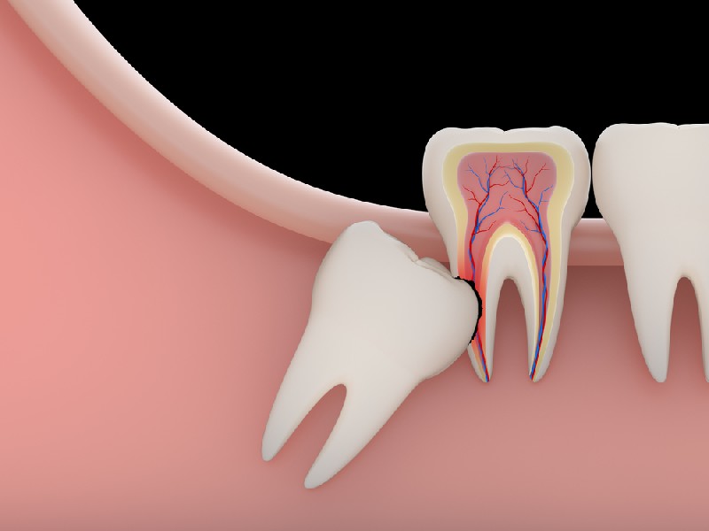 Tooth-Extraction-Mesa-AZ